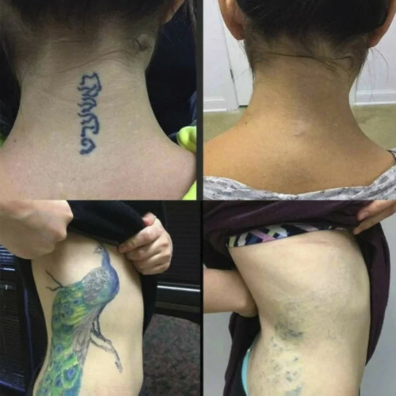 Permanent Tattoo Cream Removal