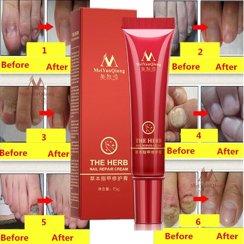 Toenail Herbal Treatment Cream